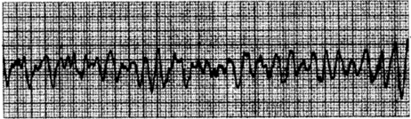 室颤:成人心脏骤停更常见的心律失常心脏骤停的判断(2:心电图表现